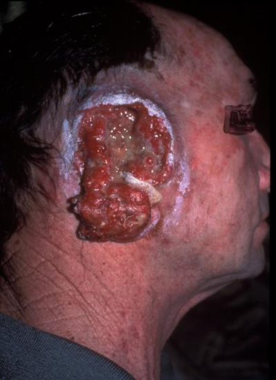 carcinome.JPG